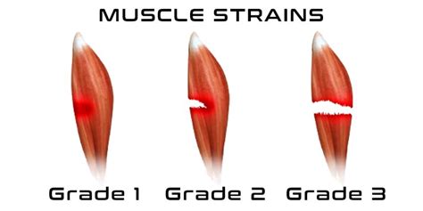 muscle strain vs muscle tear